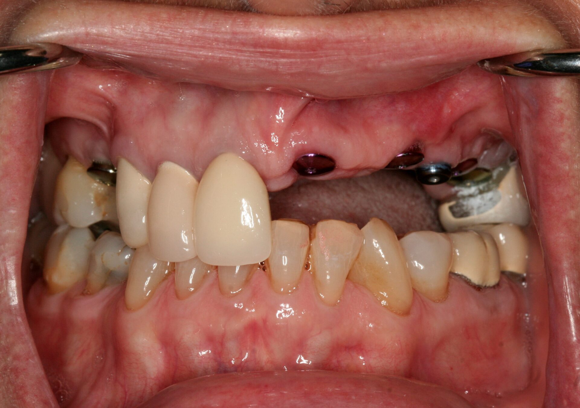 Dental Implants Case 1