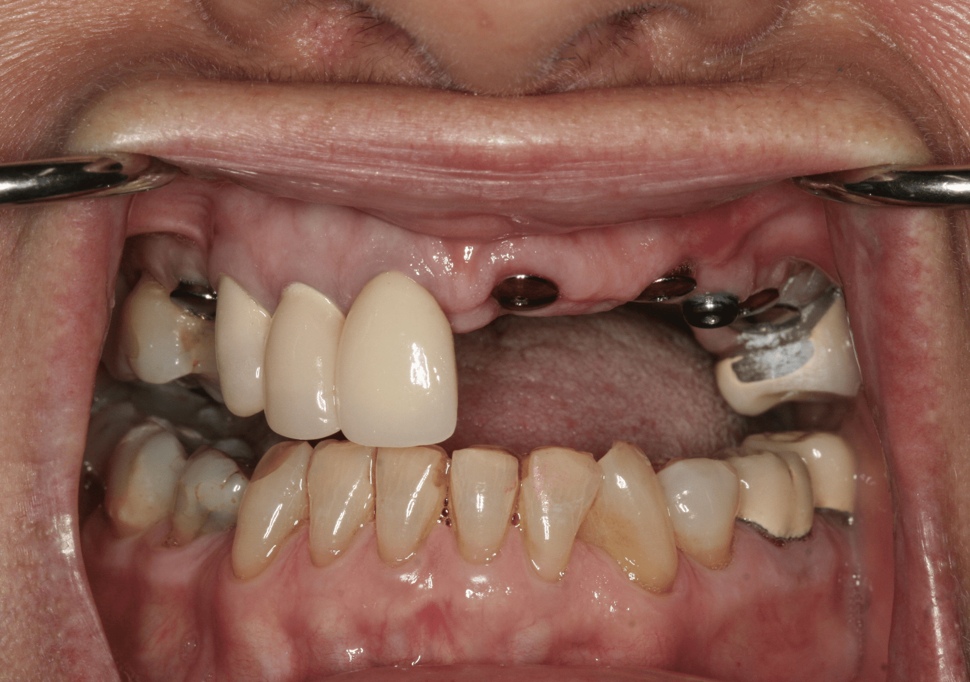 Dental Implants Case 1