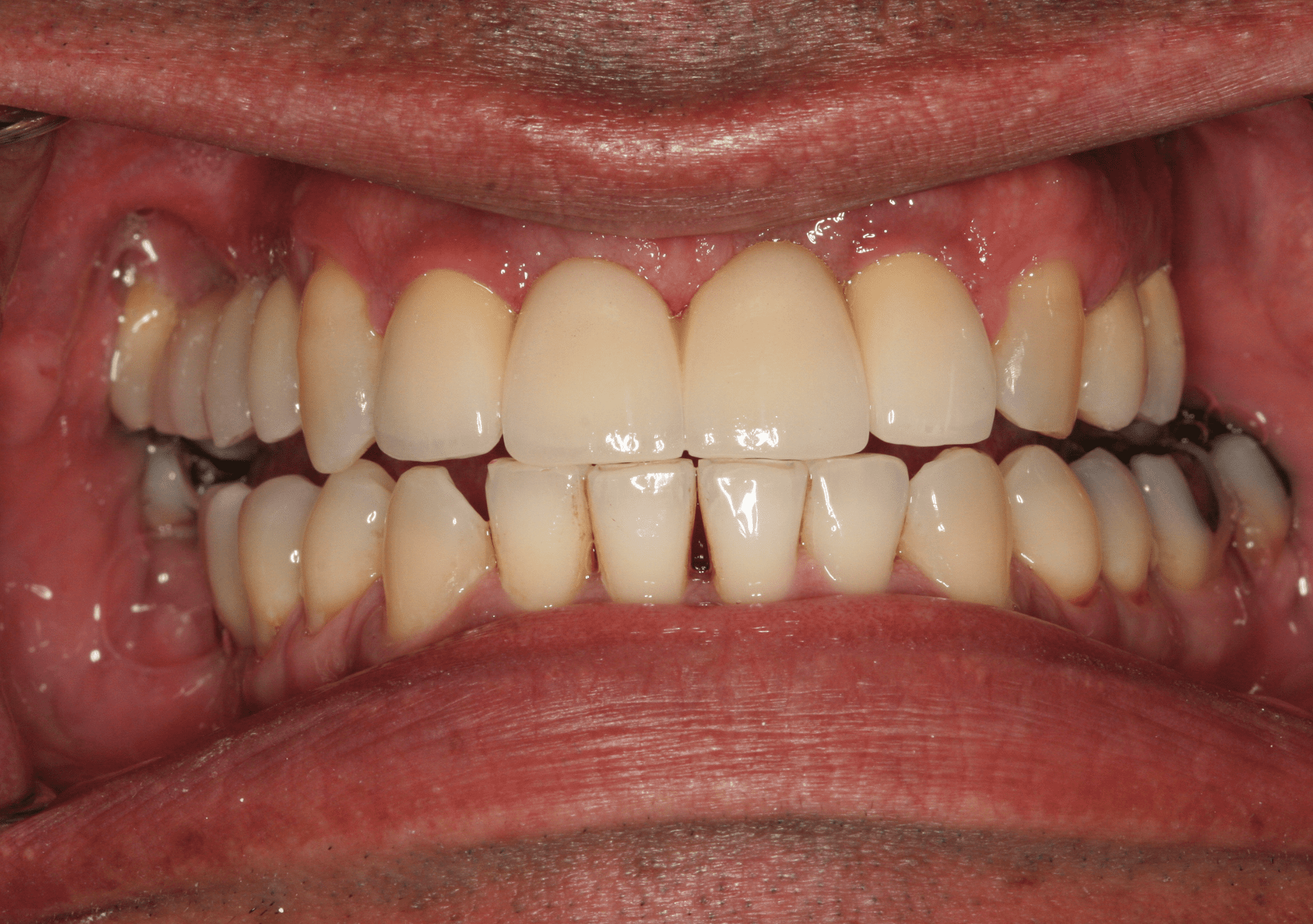 Dental Implants Case 2