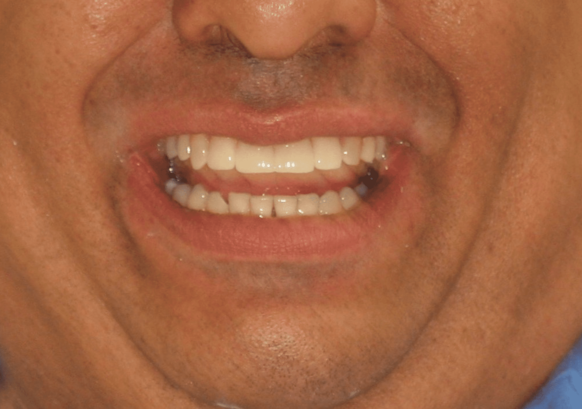 Dental Implants Case 2