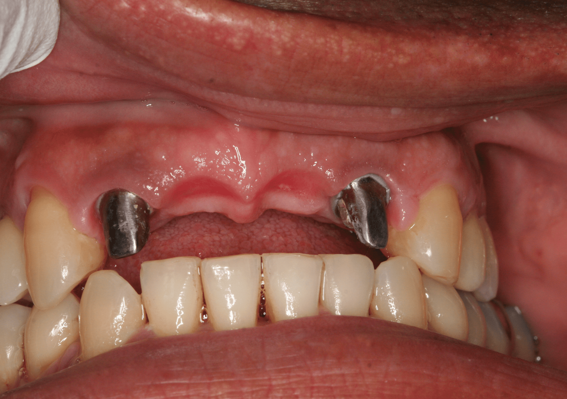 Dental Implants Case 2