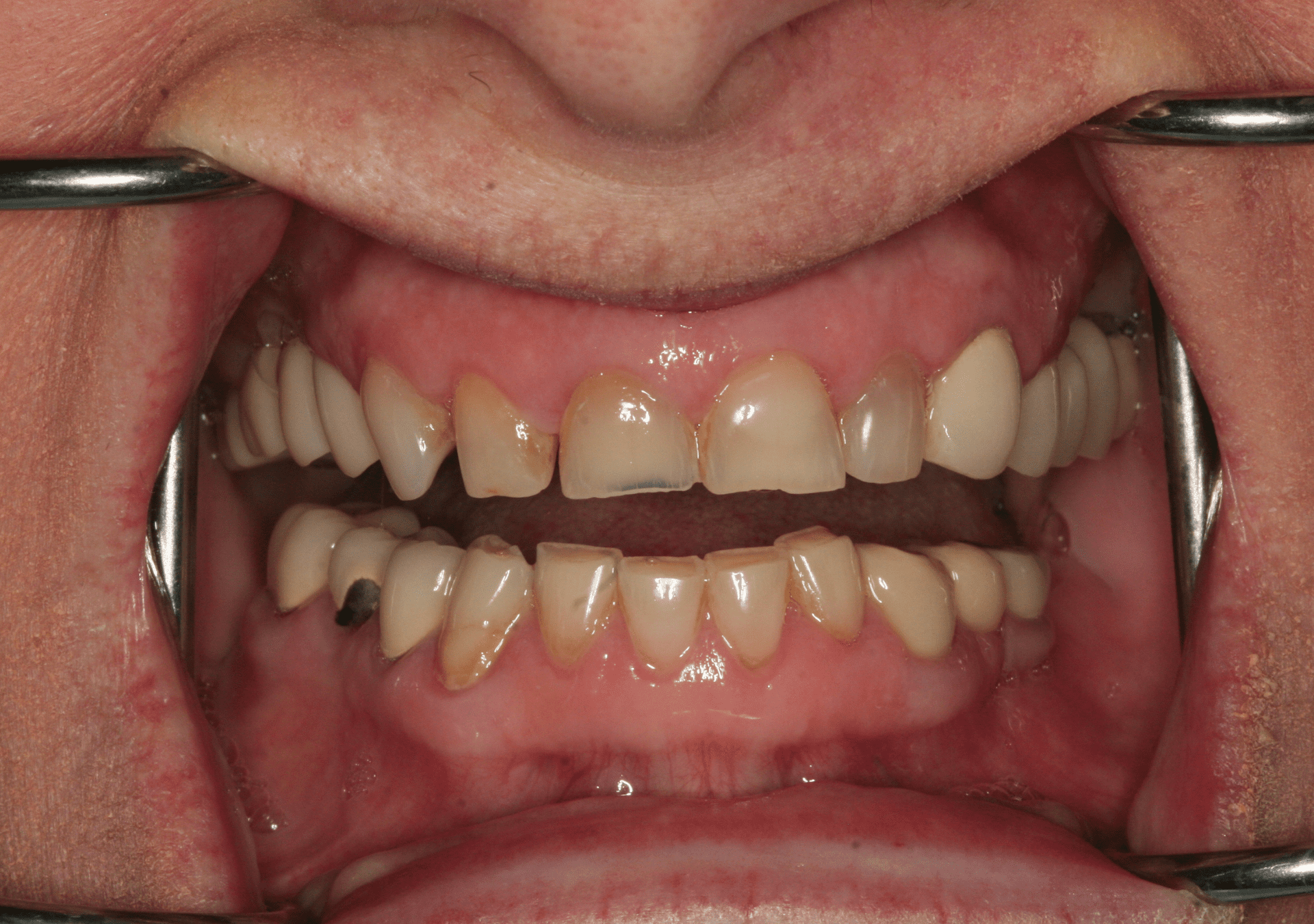 Oral Rehabilitation Case 3