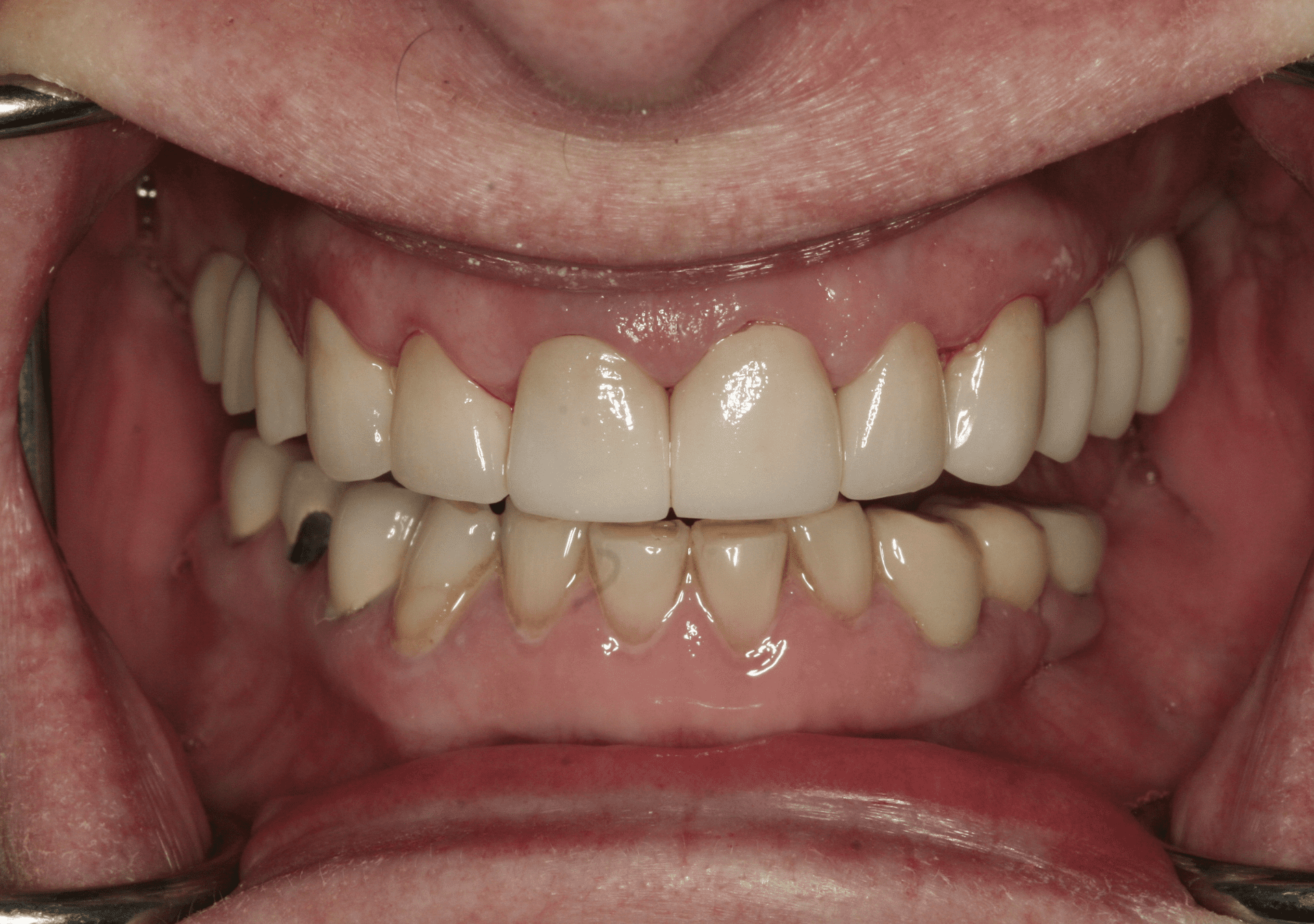 Oral Rehabilitation Case 3