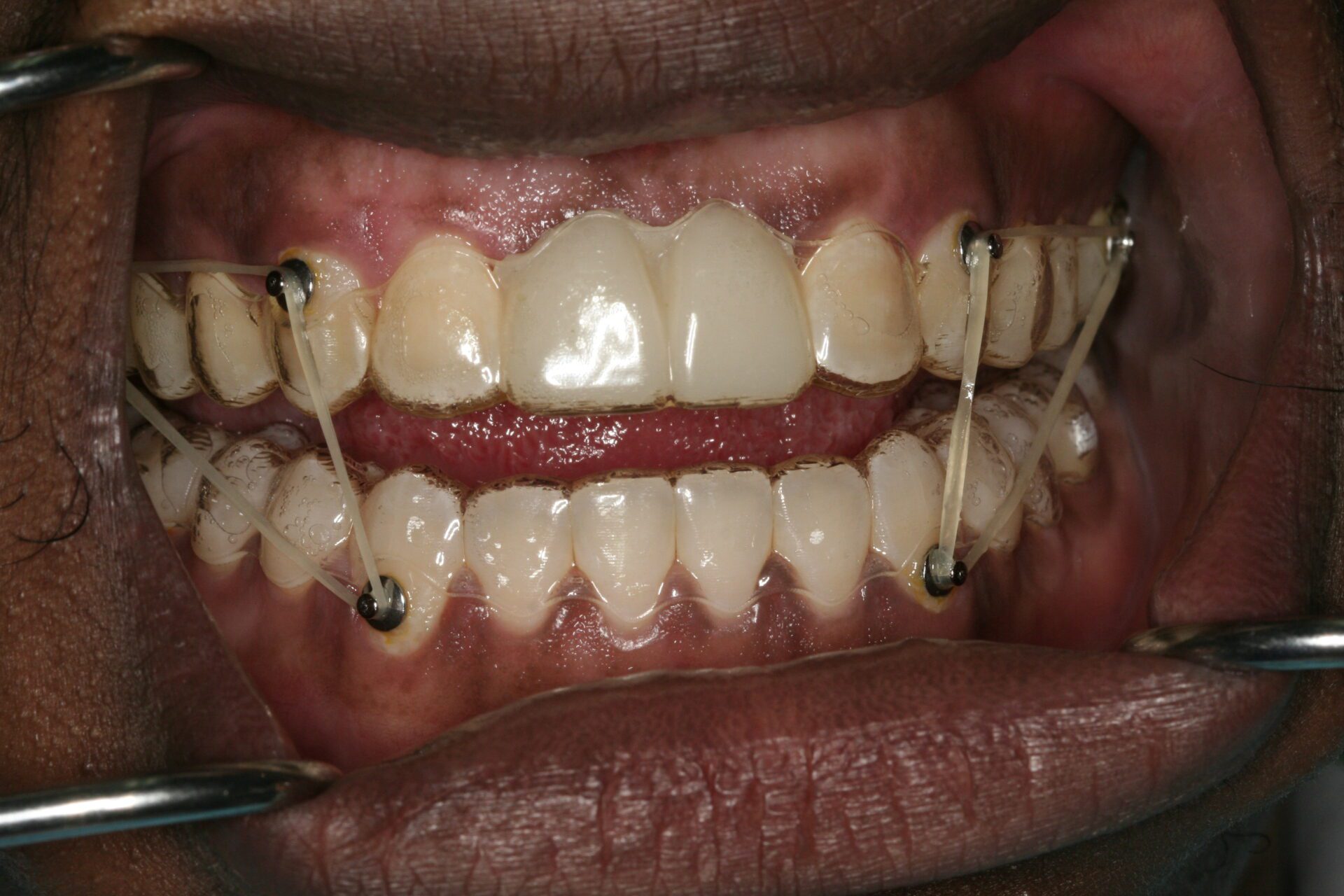 Dental Implants Case 3