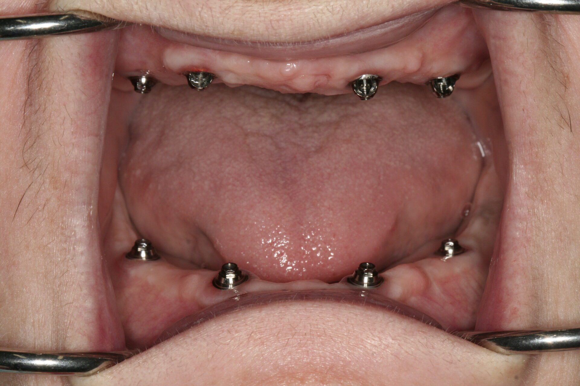 Dental Implants Case 3