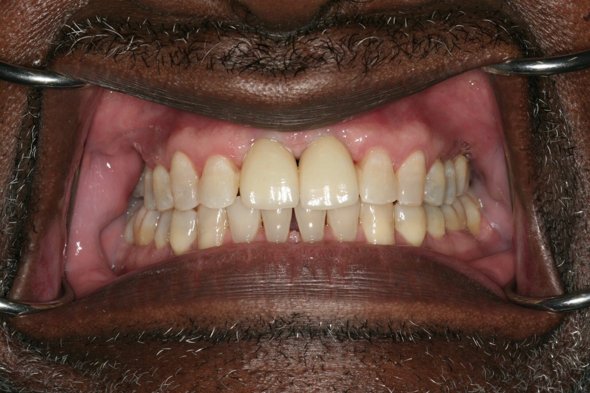 Oral Rehabilitation Case 3