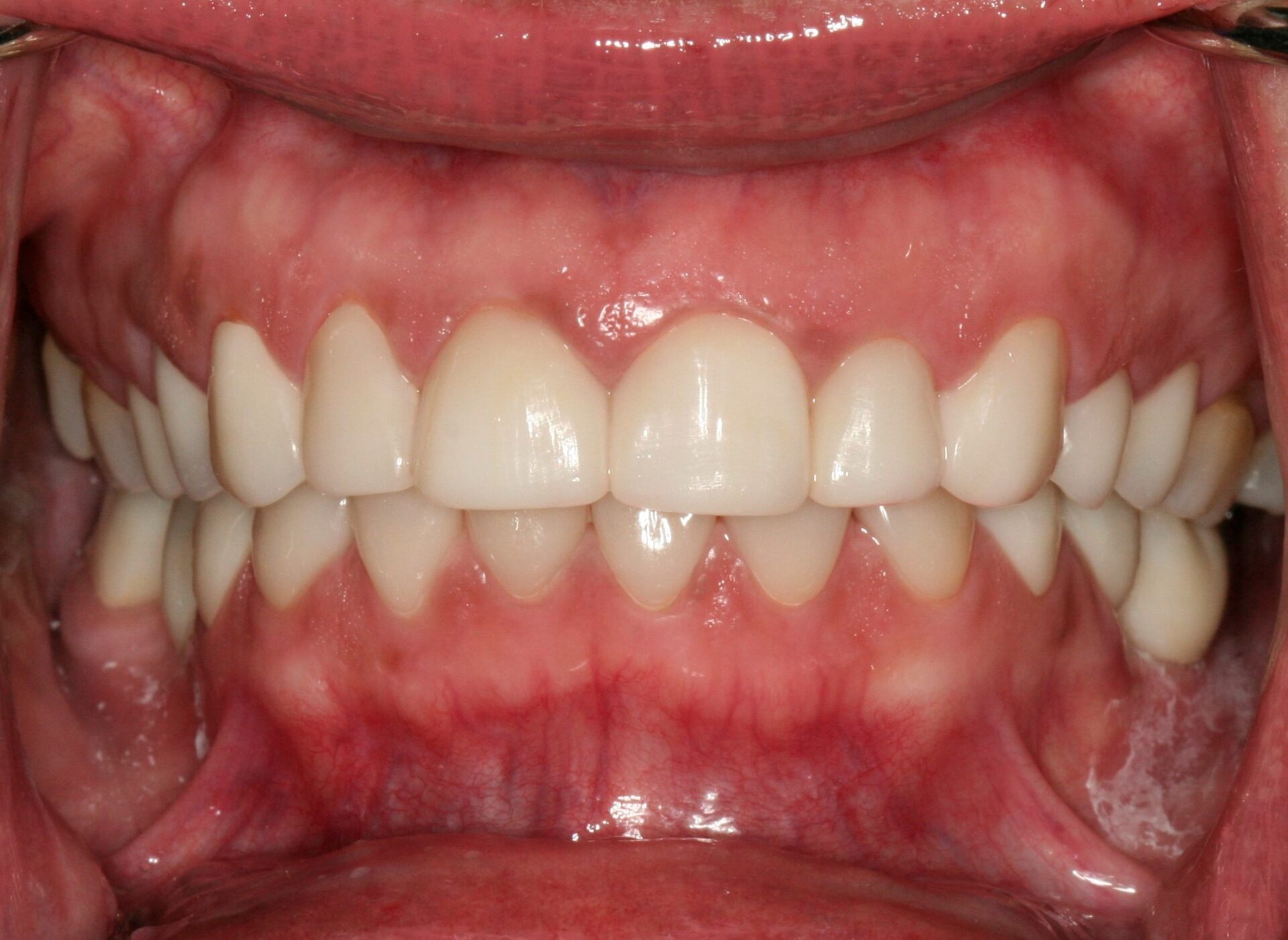 Oral Rehabilitation Case 3